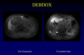 Metastatic Uveal Melanoma Treatment - 2019 CURE OM Symposium | PPTX