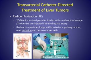 Transarterial Catheter-Directed
Treatment of Liver Tumors
• Radioembolization (RE)
• 20-60 micron-sized particles loaded w...