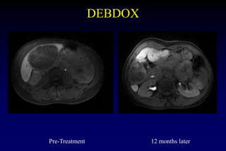 DEBDOX
Pre-Treatment 12 months later
 