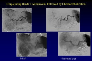 Drug-eluting Beads + Adriamycin, Followed by Chemoembolization
Initial 4 months later
 