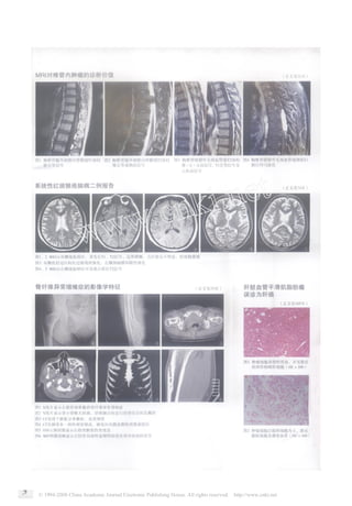 MRI对椎管内肿瘤的诊断价值