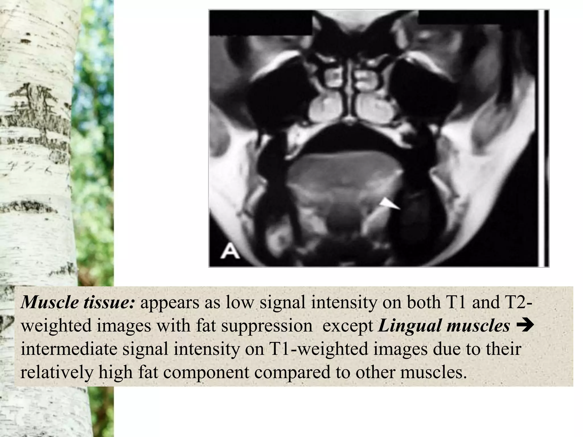 Muscle tissue: appears as low signal intensity on both T1 and T2-
weighted images with fat suppression except Lingual muscles 
intermediate signal intensity on T1-weighted images due to their
relatively high fat component compared to other muscles.
 