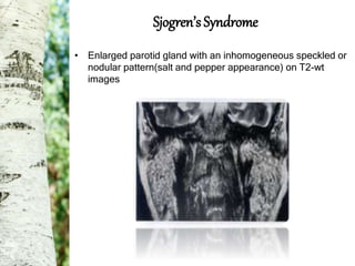 Sjogren Reticular Pattern MRI | PPTX