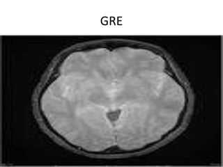 MRI Brain | PPTX