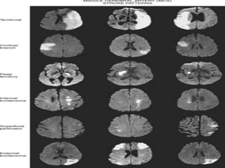MRI Brain | PPTX