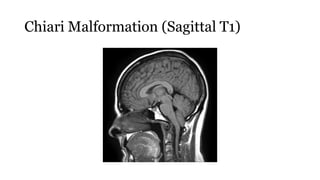 Chiari Malformation (Sagittal T1)
 