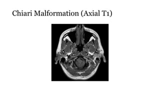 Chiari Malformation (Axial T1)
 