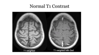 Normal T1 Contrast
 