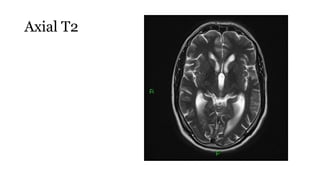 Axial T2
 