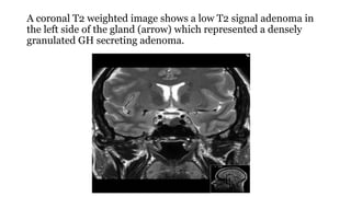 A coronal T2 weighted image shows a low T2 signal adenoma in
the left side of the gland (arrow) which represented a densely
granulated GH secreting adenoma.
 