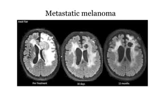Metastatic melanoma
 