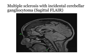 Multiple sclerosis with incidental cerebellar
gangliocytoma (Sagittal FLAIR)
 