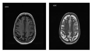 DWI
ADC
 