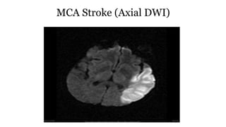 MCA Stroke (Axial DWI)
 