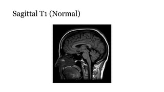 Sagittal T1 (Normal)
 