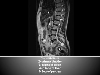 umbilicus 
moid colon 
4- rt lobe of liver 
5- 
 