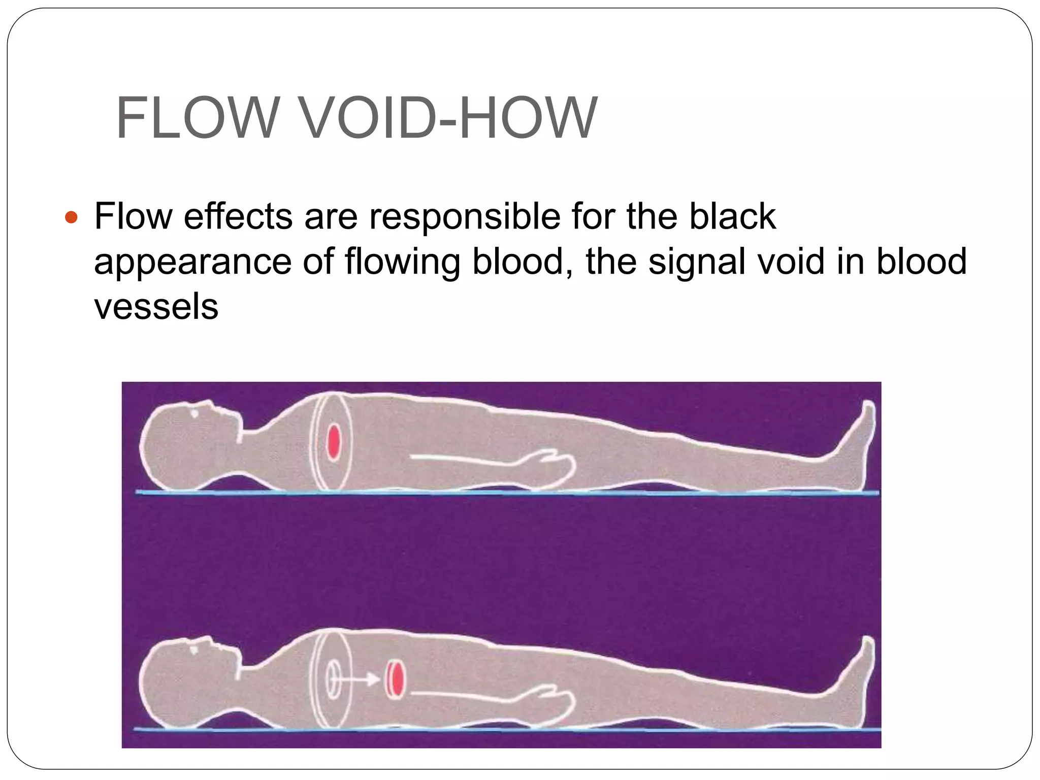 FLOW VOID-HOW
 Flow effects are responsible for the black
appearance of flowing blood, the signal void in blood
vessels
 