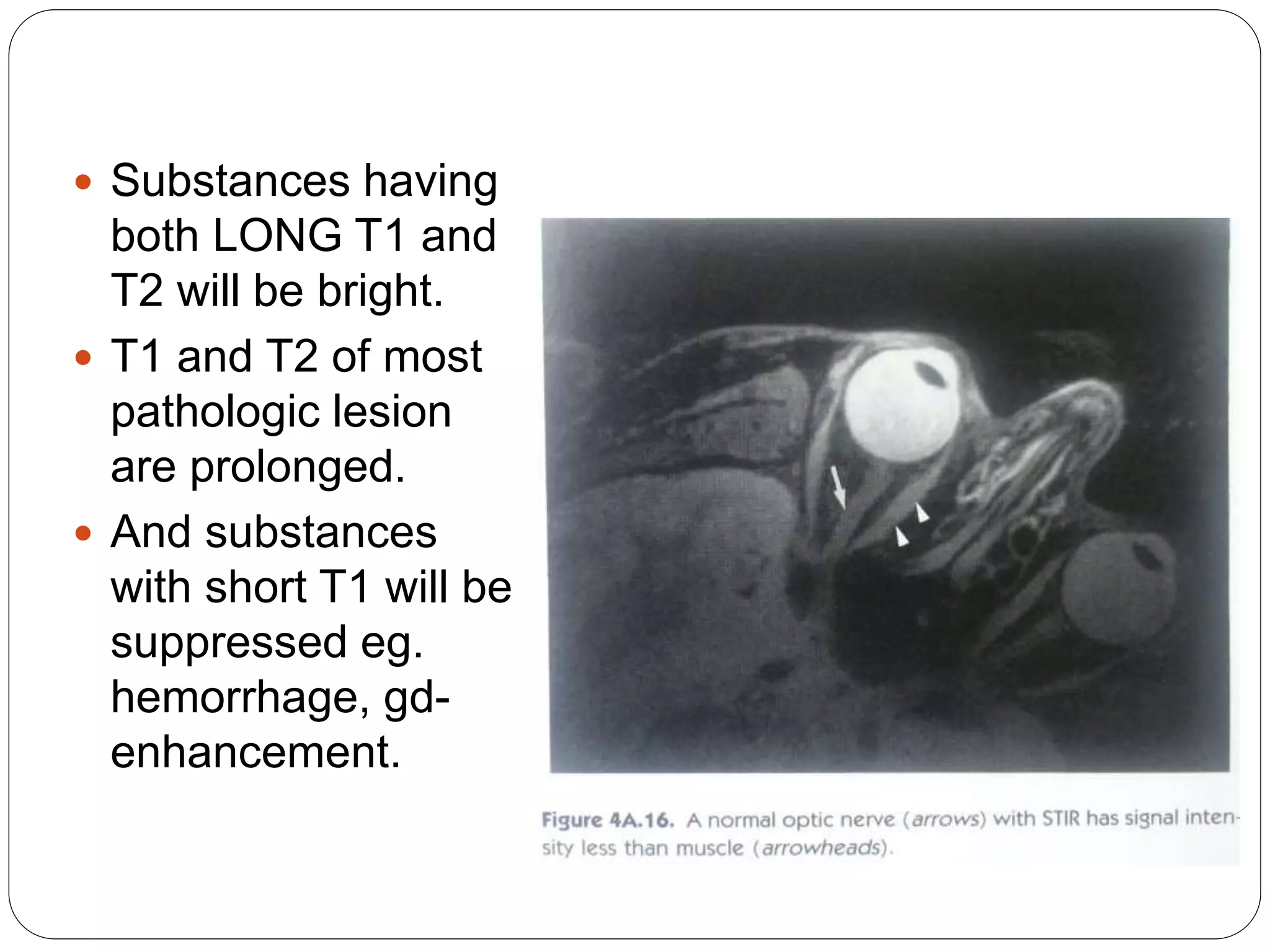  Substances having
both LONG T1 and
T2 will be bright.
 T1 and T2 of most
pathologic lesion
are prolonged.
 And substances
with short T1 will be
suppressed eg.
hemorrhage, gd-
enhancement.
 