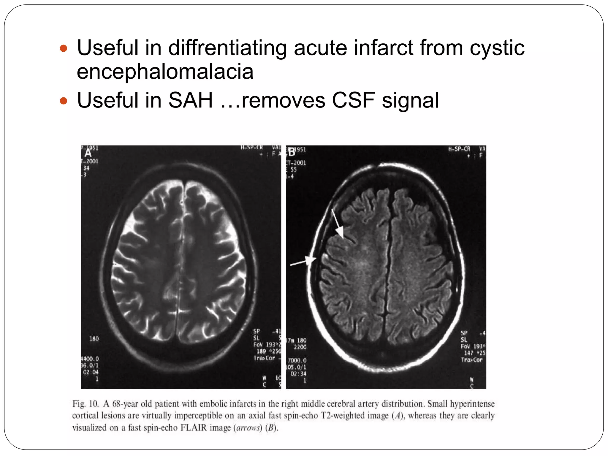  Useful in diffrentiating acute infarct from cystic
encephalomalacia
 Useful in SAH …removes CSF signal
 