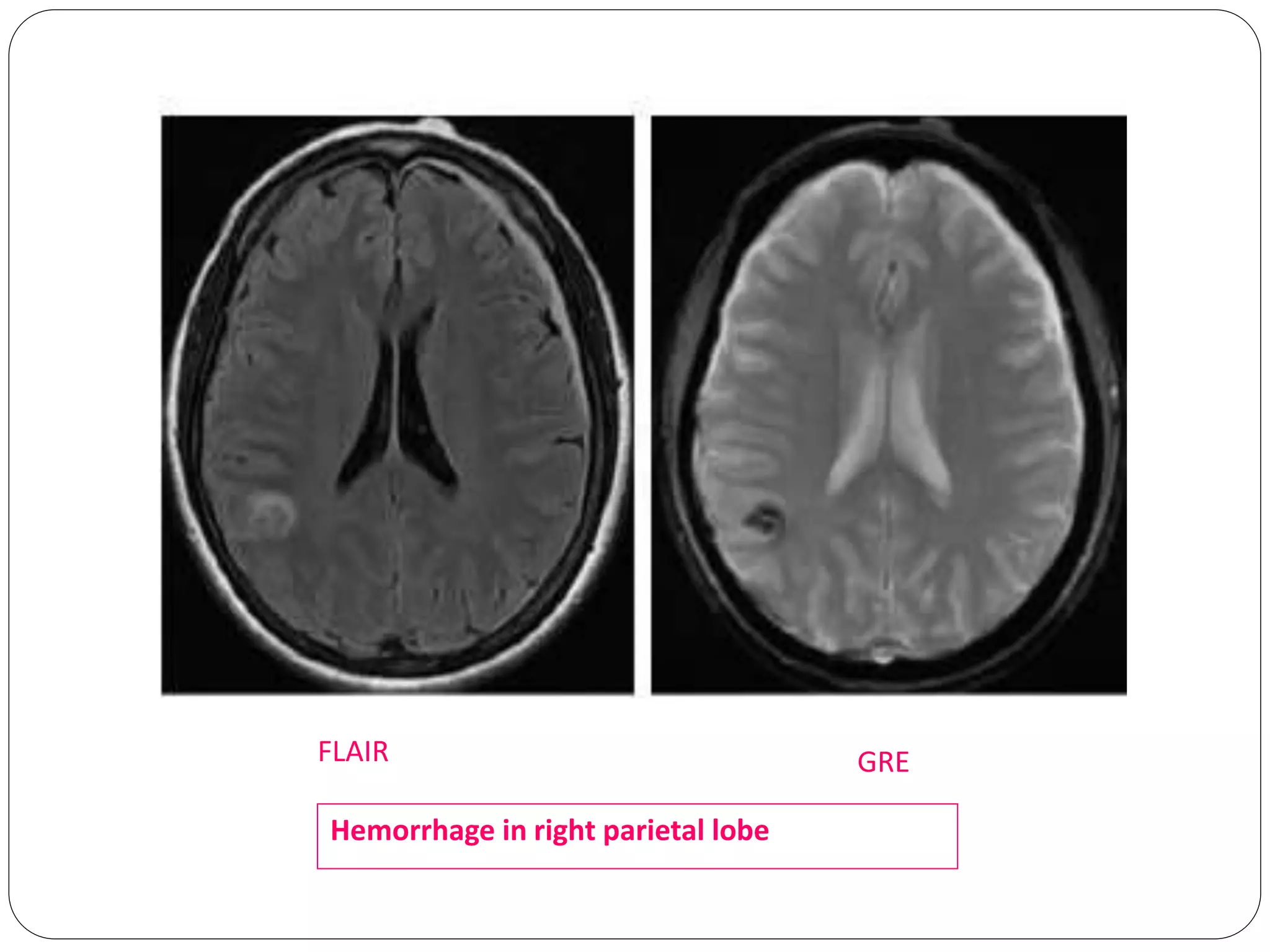 GREFLAIR
Hemorrhage in right parietal lobe
 