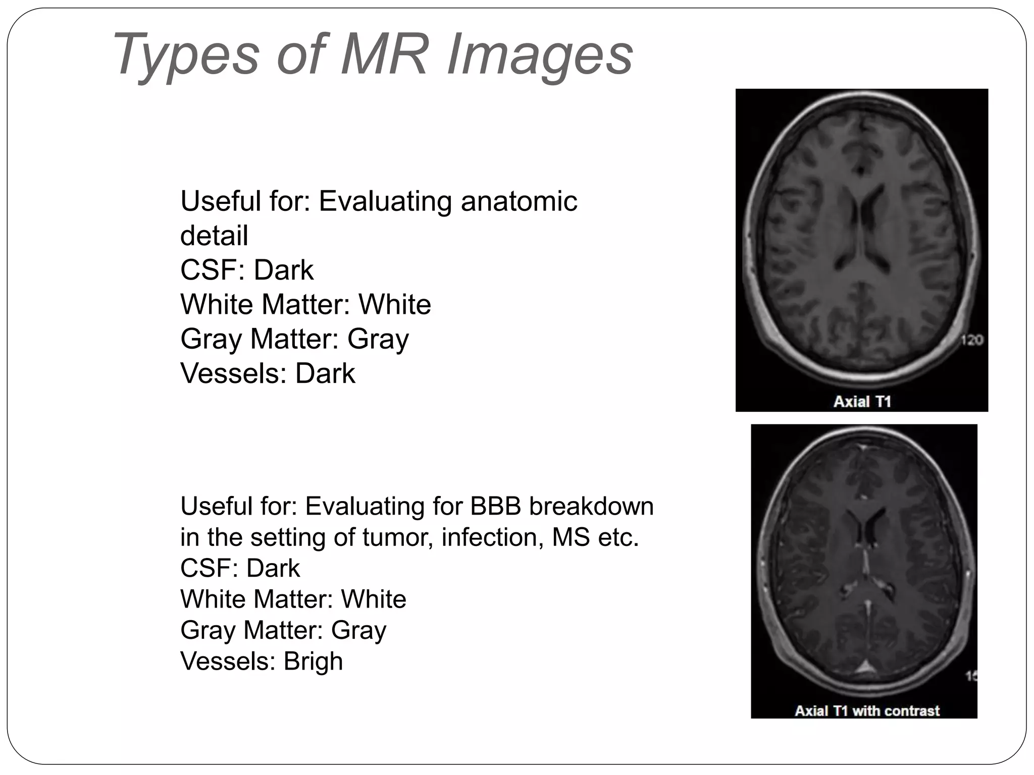 Types of MR Images
Useful for: Evaluating anatomic
detail
CSF: Dark
White Matter: White
Gray Matter: Gray
Vessels: Dark
Useful for: Evaluating for BBB breakdown
in the setting of tumor, infection, MS etc.
CSF: Dark
White Matter: White
Gray Matter: Gray
Vessels: Brigh
 