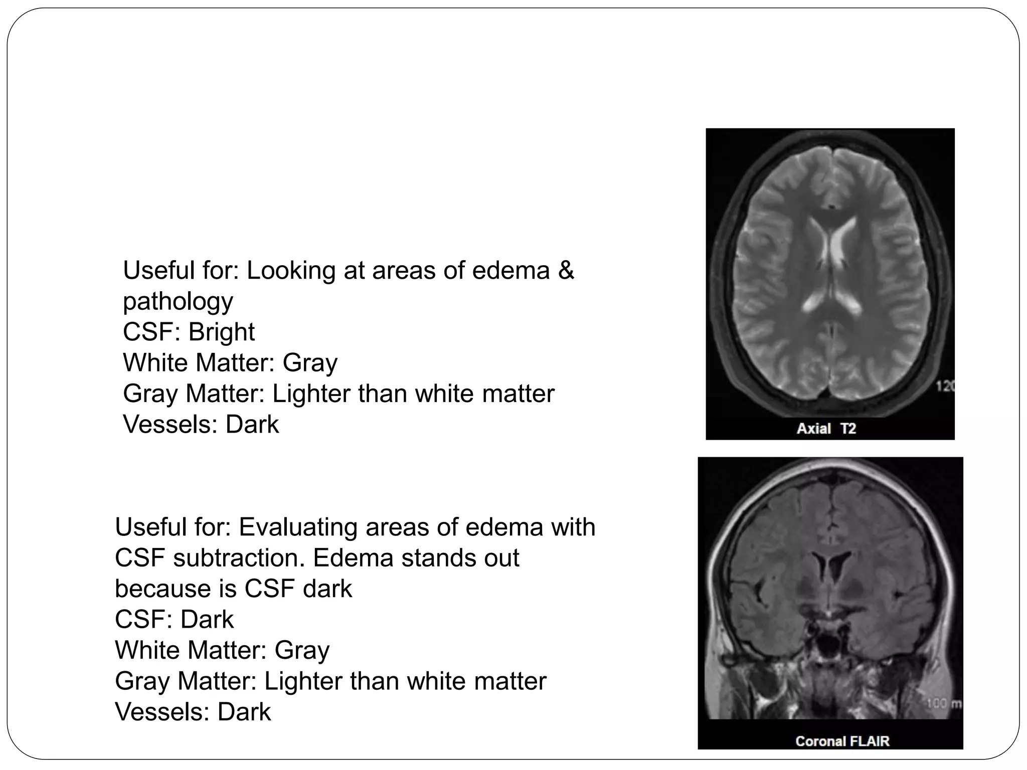Useful for: Looking at areas of edema &
pathology
CSF: Bright
White Matter: Gray
Gray Matter: Lighter than white matter
Vessels: Dark
Useful for: Evaluating areas of edema with
CSF subtraction. Edema stands out
because is CSF dark
CSF: Dark
White Matter: Gray
Gray Matter: Lighter than white matter
Vessels: Dark
 