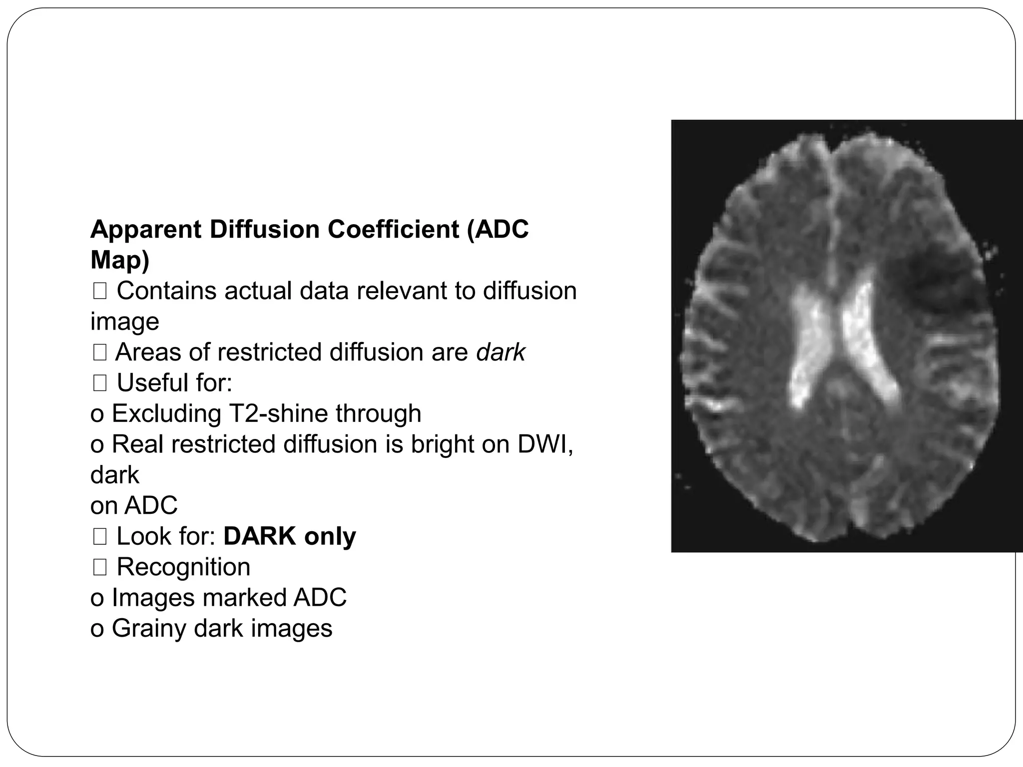 Apparent Diffusion Coefficient (ADC
Map)
Contains actual data relevant to diffusion
image
Areas of restricted diffusion are dark
Useful for:
o Excluding T2-shine through
o Real restricted diffusion is bright on DWI,
dark
on ADC
Look for: DARK only
Recognition
o Images marked ADC
o Grainy dark images
 