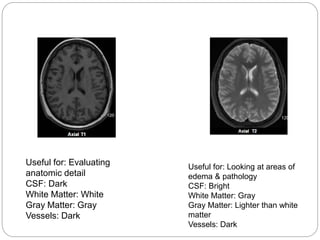 Useful for: Evaluating
anatomic detail
CSF: Dark
White Matter: White
Gray Matter: Gray
Vessels: Dark
Useful for: Looking at areas of
edema & pathology
CSF: Bright
White Matter: Gray
Gray Matter: Lighter than white
matter
Vessels: Dark
 