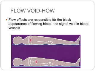 FLOW VOID-HOW
 Flow effects are responsible for the black
appearance of flowing blood, the signal void in blood
vessels
 
