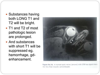  Substances having
both LONG T1 and
T2 will be bright.
 T1 and T2 of most
pathologic lesion
are prolonged.
 And substances
with short T1 will be
suppressed eg.
hemorrhage, gd-
enhancement.
 