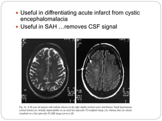  Useful in diffrentiating acute infarct from cystic
encephalomalacia
 Useful in SAH …removes CSF signal
 