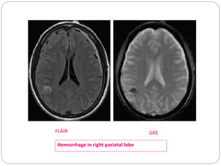 GREFLAIR
Hemorrhage in right parietal lobe
 
