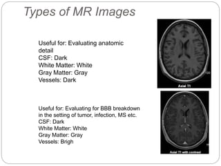Types of MR Images
Useful for: Evaluating anatomic
detail
CSF: Dark
White Matter: White
Gray Matter: Gray
Vessels: Dark
Useful for: Evaluating for BBB breakdown
in the setting of tumor, infection, MS etc.
CSF: Dark
White Matter: White
Gray Matter: Gray
Vessels: Brigh
 