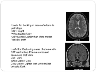 Useful for: Looking at areas of edema &
pathology
CSF: Bright
White Matter: Gray
Gray Matter: Lighter than white matter
Vessels: Dark
Useful for: Evaluating areas of edema with
CSF subtraction. Edema stands out
because is CSF dark
CSF: Dark
White Matter: Gray
Gray Matter: Lighter than white matter
Vessels: Dark
 