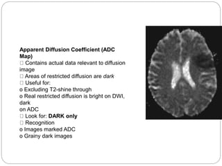 Apparent Diffusion Coefficient (ADC
Map)
Contains actual data relevant to diffusion
image
Areas of restricted diffusion are dark
Useful for:
o Excluding T2-shine through
o Real restricted diffusion is bright on DWI,
dark
on ADC
Look for: DARK only
Recognition
o Images marked ADC
o Grainy dark images
 