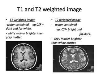 T1 and T2 weighted image
• T1 weighted image
-water contained eg.CSF –
dark and fat-white.
- white matter brighter than
grey matter.
• T2 weighted image
- water contained
eg. CSF- bright and
fat-dark.
- Grey matter brighter
than white matter.
 