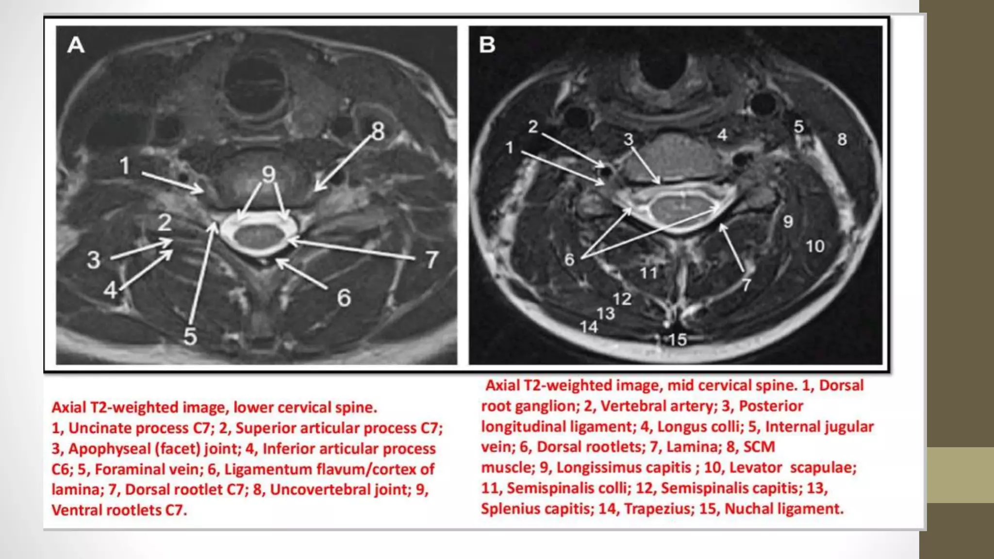 MRI-in Spine PPT.pptx