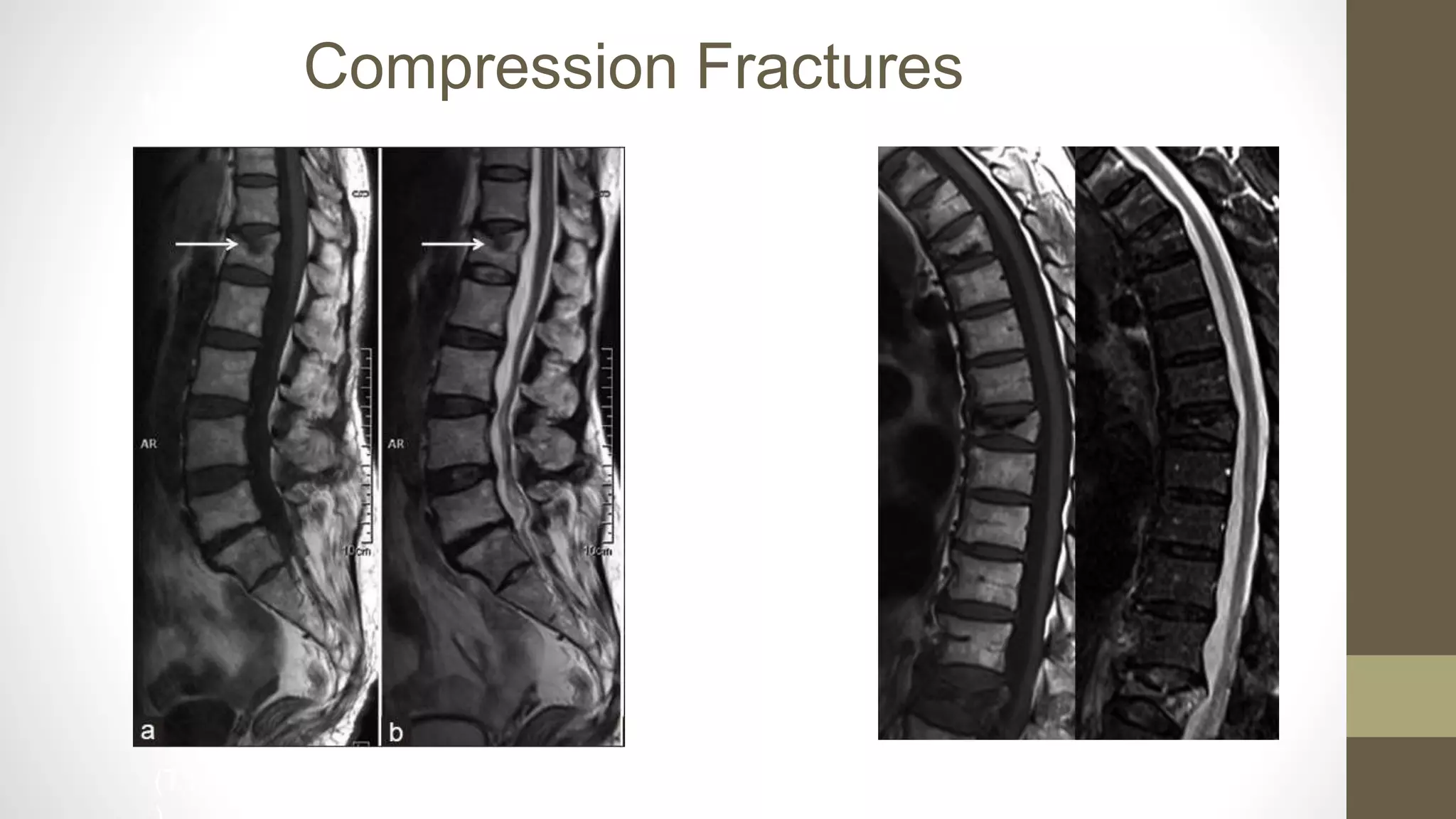 MRI-in Spine PPT.pptx