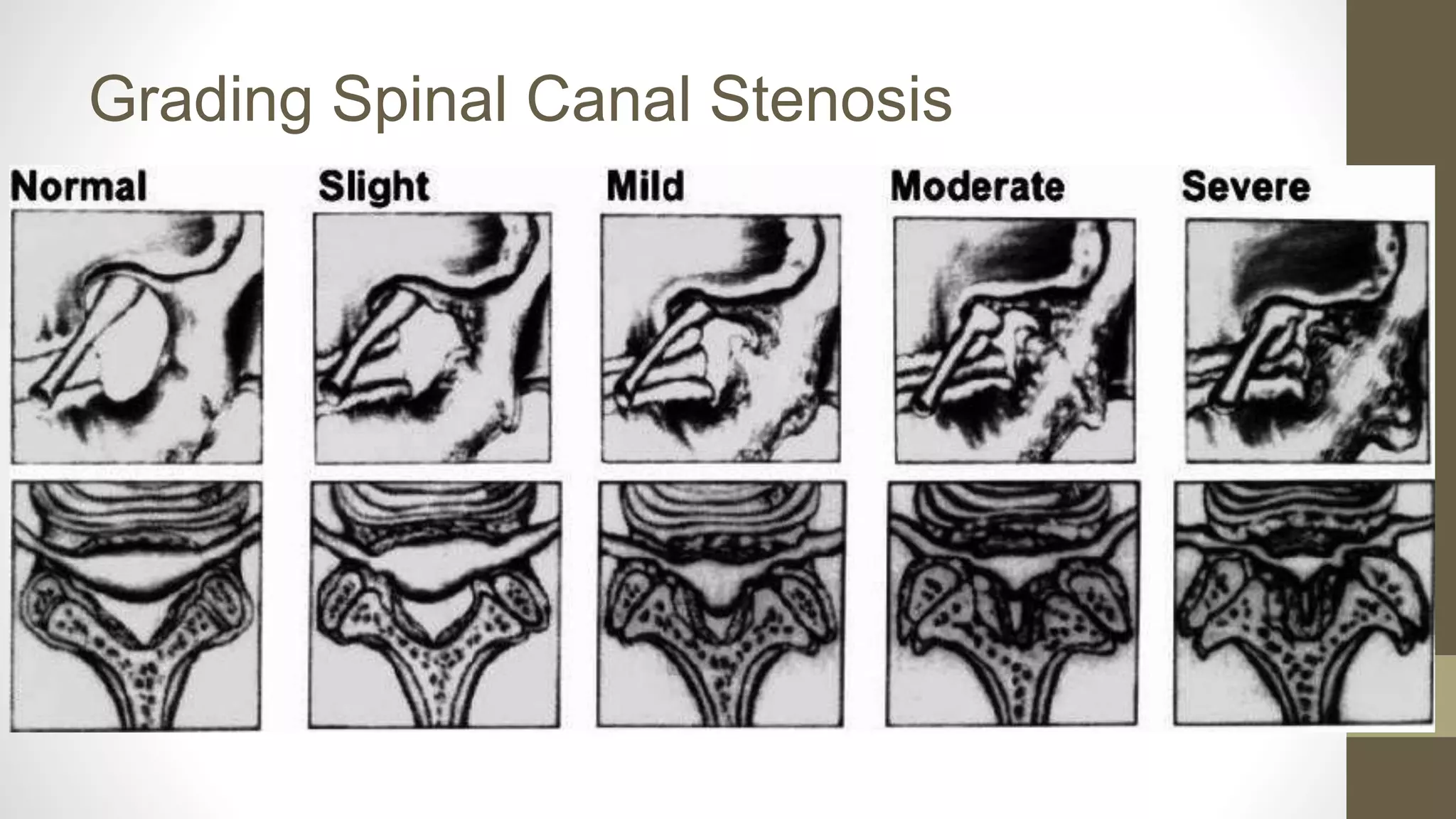 Spine Rotation Grading MRI-in Spine PPT.pptx