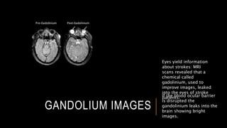 GANDOLIUM IMAGES
If the blood ocular barrier
is disrupted the
gandolinium leaks into the
brain showing bright
images.
Eyes yield information
about strokes: MRI
scans revealed that a
chemical called
gadolinium, used to
improve images, leaked
into the eyes of stroke
patients.
 