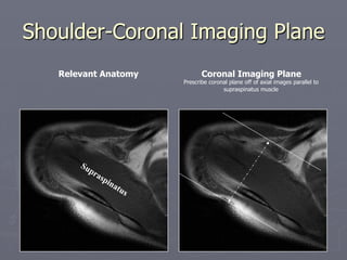 Shoulder-Coronal Imaging Plane
Coronal Imaging Plane
Prescribe coronal plane off of axial images parallel to
supraspinatus muscle
Relevant Anatomy
 