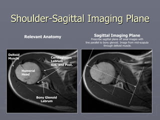 Shoulder-Sagittal Imaging Plane
Humeral
Head
Bony Glenoid
Labrum
Cartilaginous
Labrum
Ant. and Post.
Relevant Anatomy Sagittal Imaging Plane
Prescribe sagittal plane off axial images with
line parallel to bony glenoid. Image from mid-scapula
through deltoid muscle.
Deltoid
Muscle
 