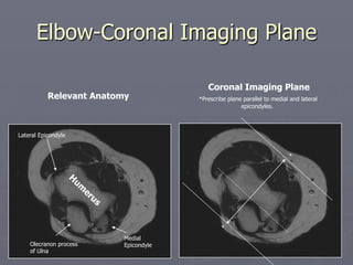 Elbow-Coronal Imaging Plane
Relevant Anatomy
Coronal Imaging Plane
*Prescribe plane parallel to medial and lateral
epicondyles.
*
*
Lateral Epicondyle
Medial
Epicondyle
Olecranon process
of Ulna
 