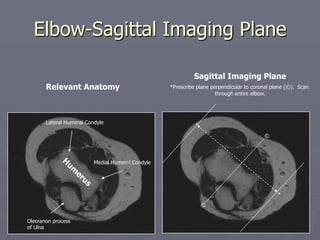 Elbow-Sagittal Imaging Plane
Sagittal Imaging Plane
*Prescribe plane perpendicular to coronal plane (©). Scan
through entire elbow.
©
©
*
*
Lateral Humeral Condyle
Medial Humeral Condyle
Olecranon process
of Ulna
Relevant Anatomy
 