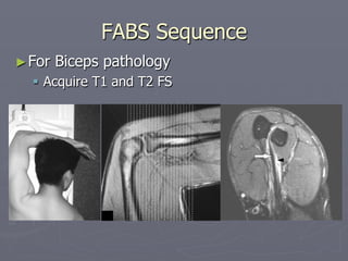 FABS Sequence
►For Biceps pathology
§ Acquire T1 and T2 FS
 