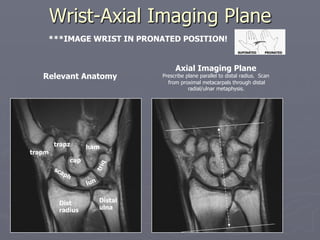 Wrist-Axial Imaging Plane
Distal
ulna
cap
Dist
radius
trapm
trapz ham
Relevant Anatomy
Axial Imaging Plane
Prescribe plane parallel to distal radius. Scan
from proximal metacarpals through distal
radial/ulnar metaphysis.
***IMAGE WRIST IN PRONATED POSITION!
SUPINATED PRONATED
 