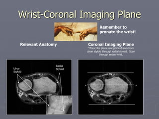 Wrist-Coronal Imaging Plane
Relevant Anatomy Coronal Imaging Plane
*Prescribe plane along line drawn from
ulnar styloid through radial styloid. Scan
through entire wrist.
* *
Ulnar
Styloid
Radial
Styloid
Remember to
pronate the wrist!
 