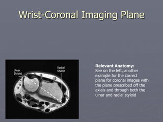 Wrist-Coronal Imaging Plane
Ulnar
Styloid
Radial
Styloid
Relevant Anatomy:
See on the left, another
example for the correct
plane for coronal images with
the plane prescribed off the
axials and through both the
ulnar and radial styloid
Ulnar
Styloid
Radial
Styloid
 