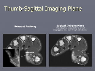 Thumb-Sagittal Imaging Plane
Sesamoids
Thumb
Relevant Anatomy Sagittal Imaging Plane
*Prescribe plane perpendicular to coronal
imaging plane (©). Scan through entire thumb.
©
*
 