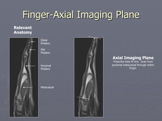 Finger-Axial Imaging Plane
Distal
Phalanx
Mid
Phalanx
Metacarpal
Proximal
Phalanx
Relevant
Anatomy
Axial Imaging Plane
Prescribe best fit line. Scan from
proximal metacarpal through entire
finger.
 